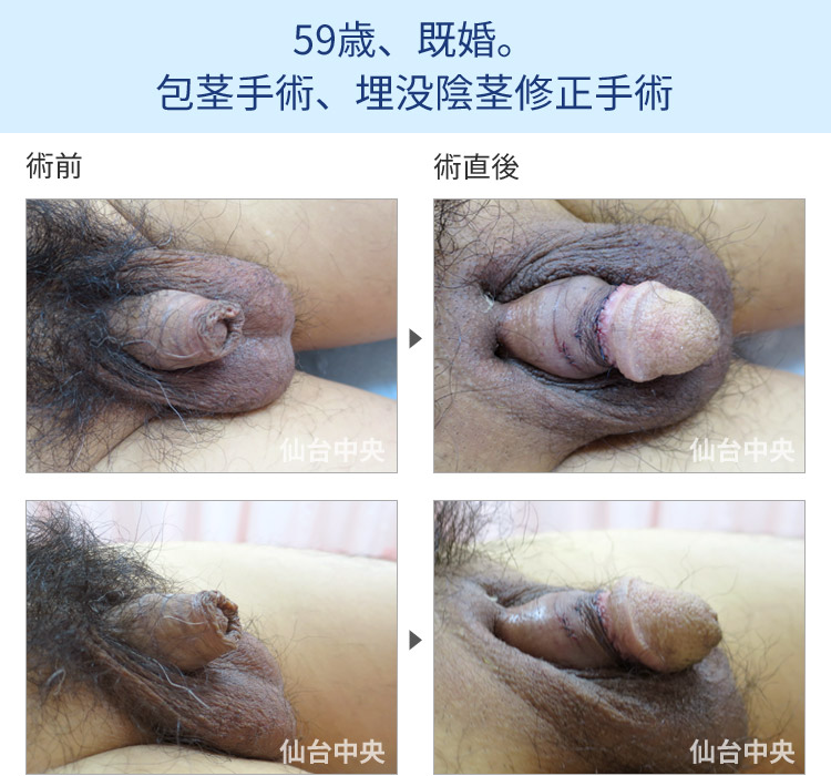 59歳、既婚。包茎手術、埋没陰茎修正手術