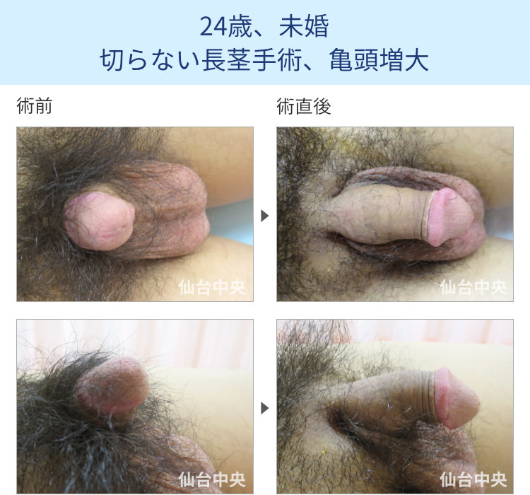 24歳、未婚。切らない長茎手術、亀頭増大