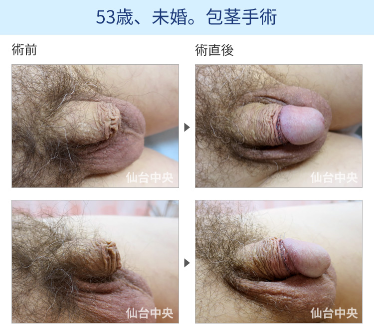 53歳、未婚。包茎手術