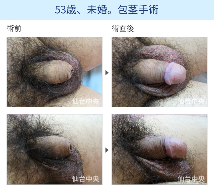43歳、既婚。包茎手術