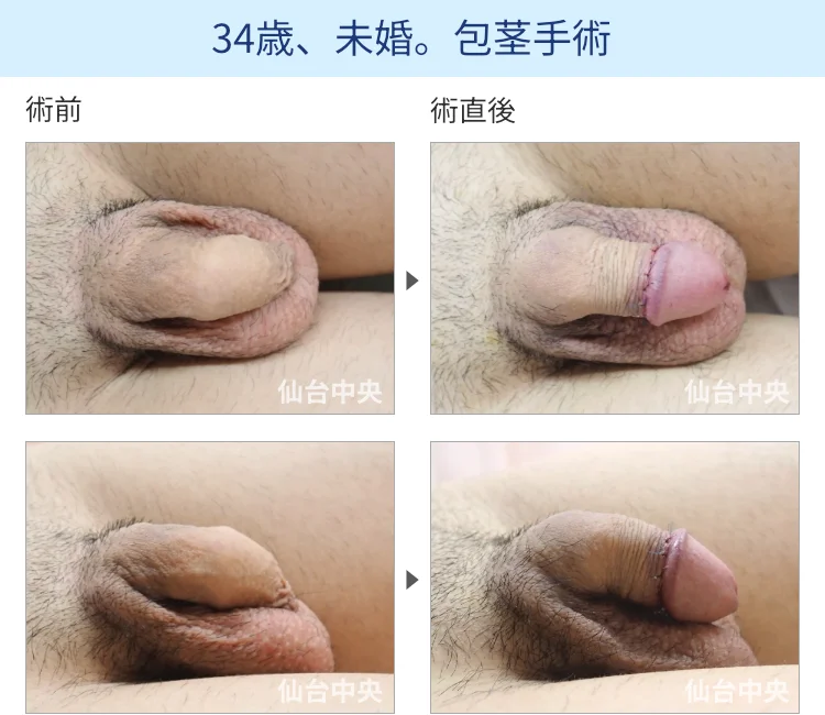 34歳、未婚。包茎手術の症例写真