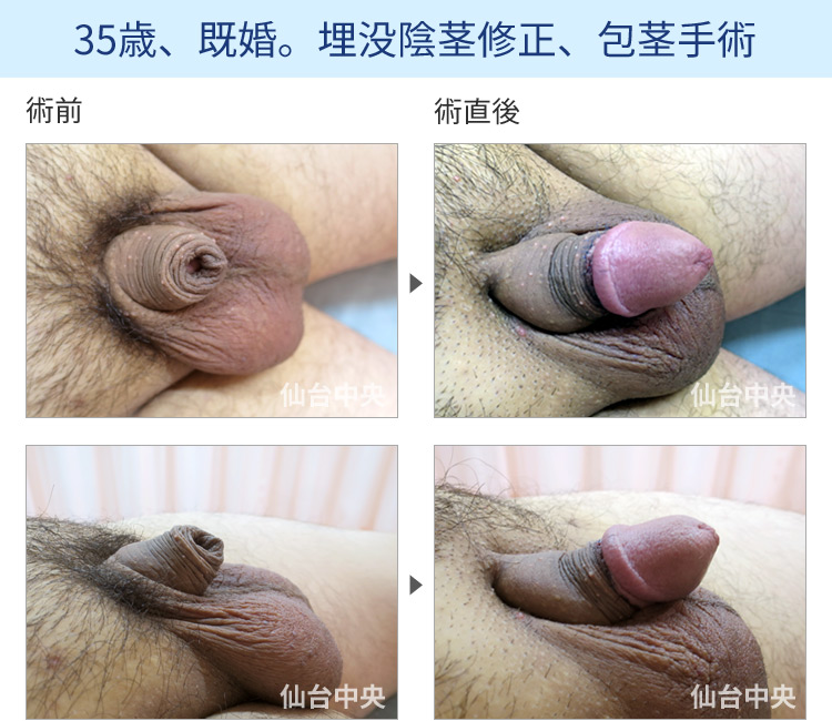 35歳、既婚。埋没陰茎修正、包茎手術