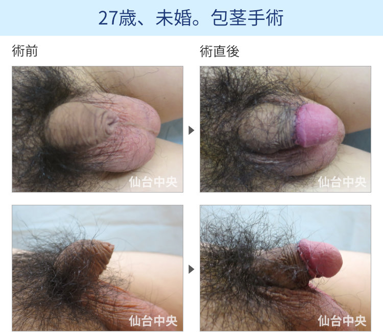 絞扼性包茎への手術症例写真、術前・術直後の比較 - 20代男性