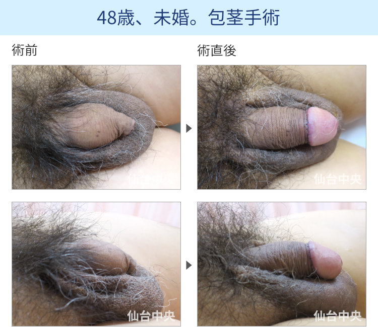 絞扼性包茎の手術症例写真、術前・術直後の比較 - 40代男性