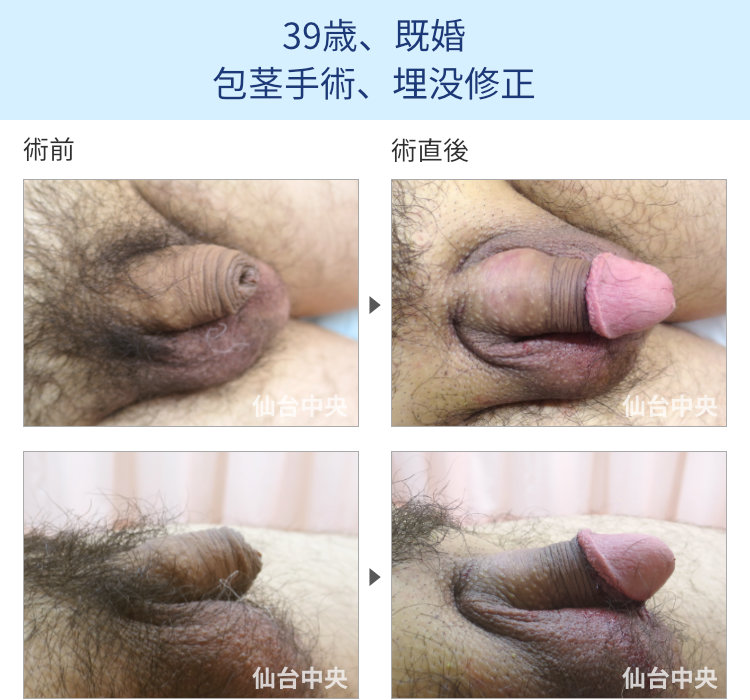 39歳、既婚。包茎手術、埋没修正