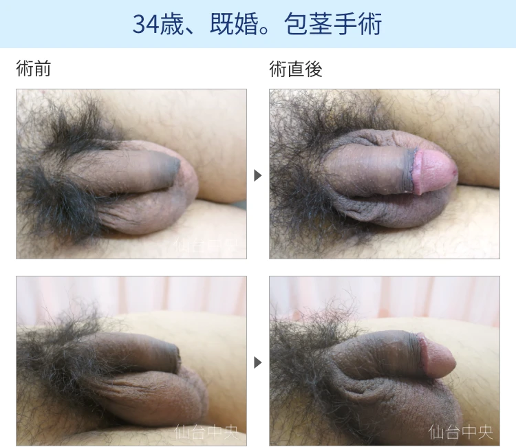 34歳、既婚。包茎手術
