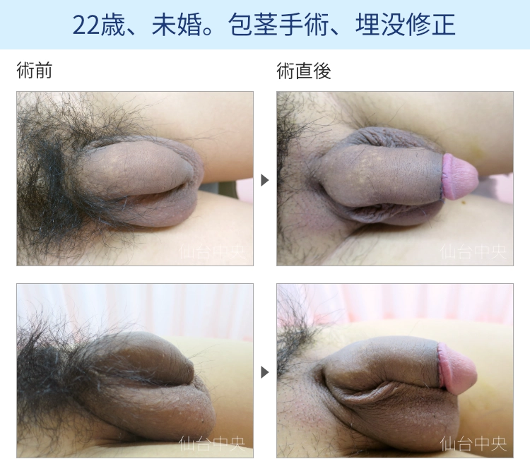 22歳、未婚。包茎手術、埋没修正