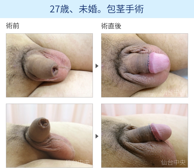 27歳、未婚。包茎手術