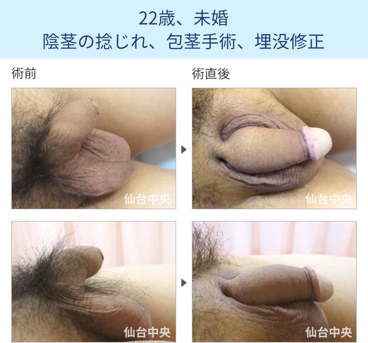左に捻じれた陰茎手術症例写真、術前・術直後の比較 - 20代男性