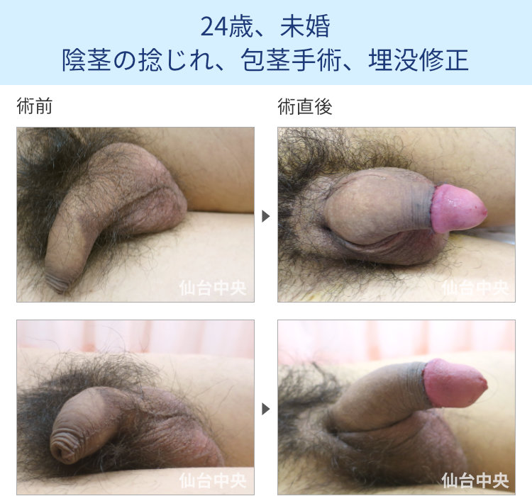 右に捻じれた陰茎手術症例写真、術前・術直後の比較 - 20代男性