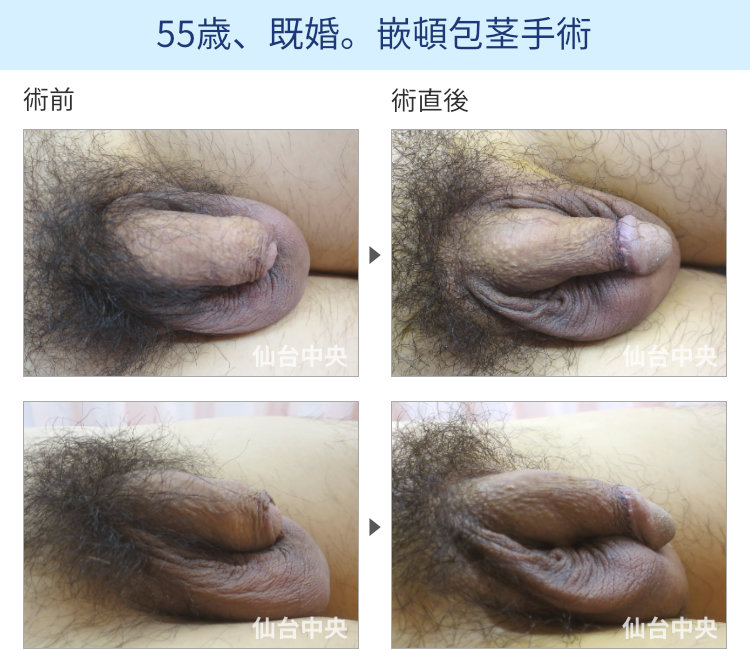 55歳、既婚。嵌頓包茎手術