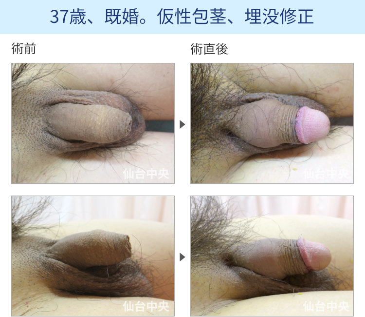 37歳、既婚。仮性包茎、埋没修正