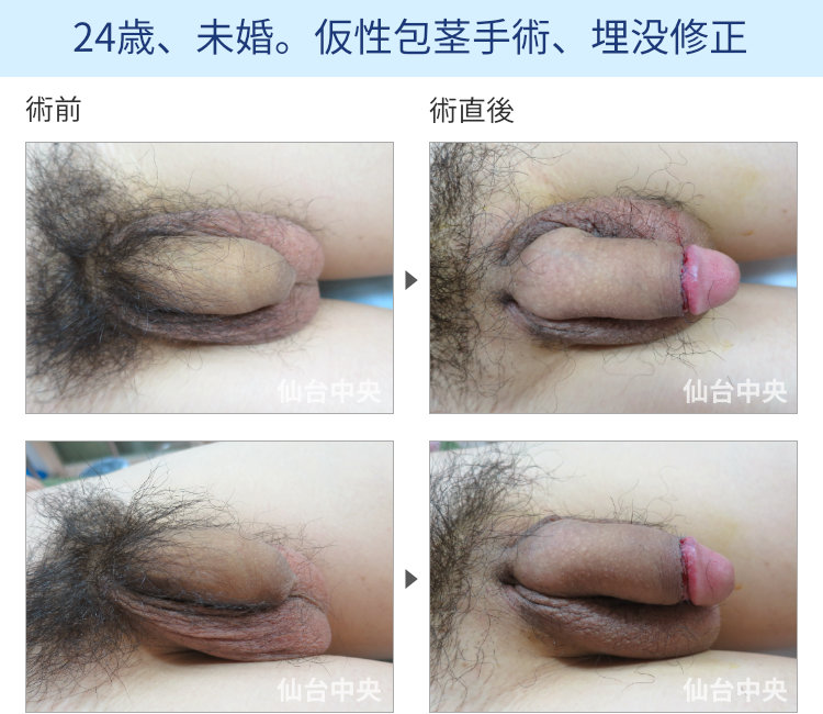 24歳、未婚。仮性包茎手術、埋没修正
