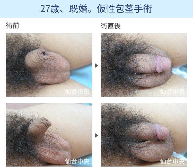 27歳、既婚。仮性包茎手術