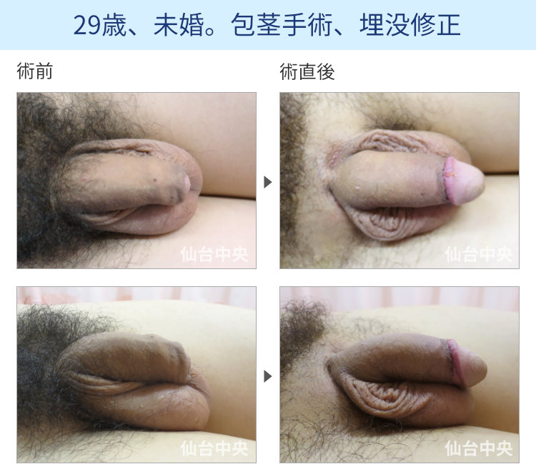 29歳、未婚。包茎手術、埋没修正