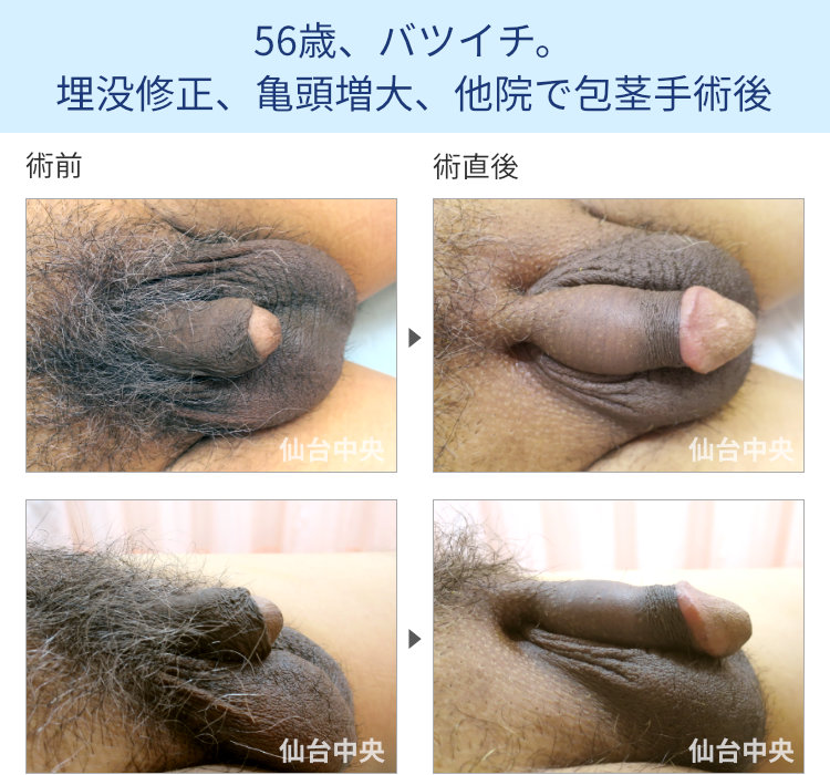 56歳、バツイチ。埋没修正、亀頭増大、他院で包茎手術後