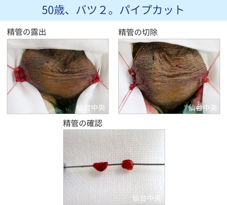 50歳、バツ2。パイプカット
