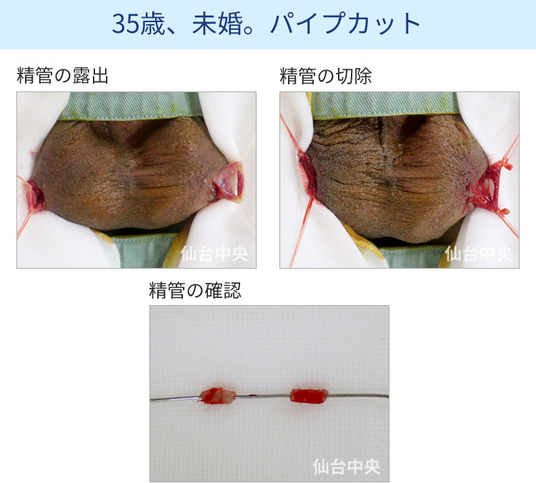 35歳、未婚。パイプカット