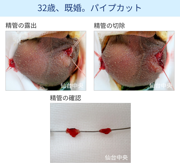 32歳、既婚。パイプカット