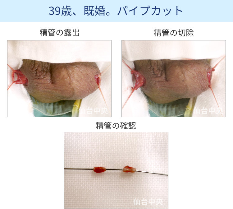 パイプカット手術の切開、露出、切除経過写真 - 30代男性