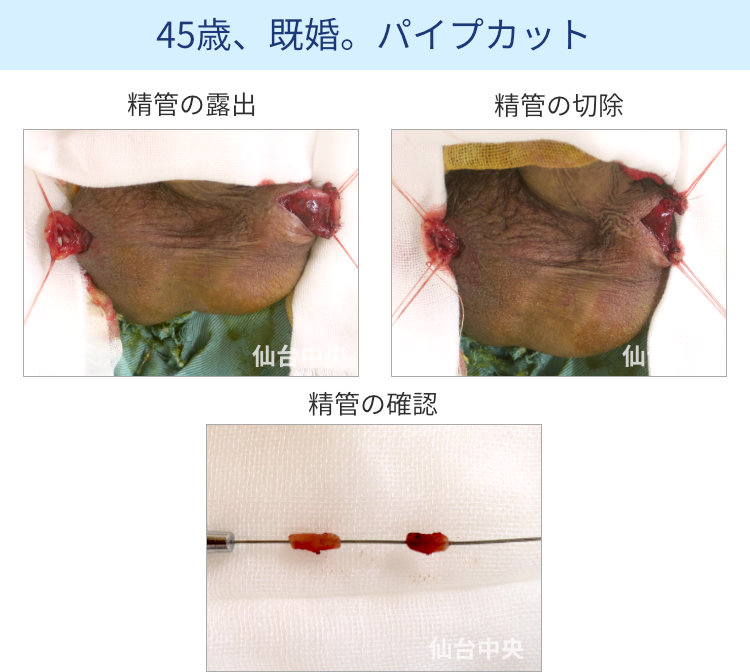 パイプカット手術の切開、露出、切除経過写真 - 40代男性