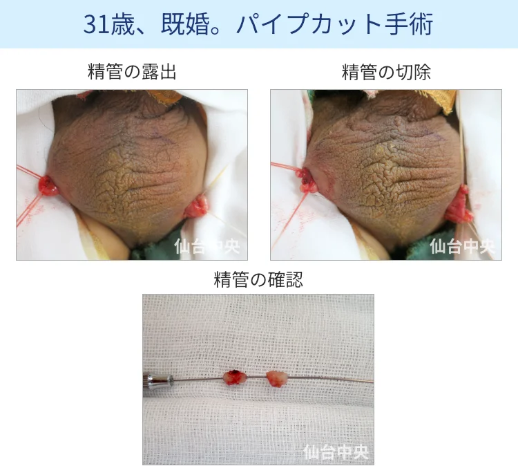 パイプカット手術の切開、露出、切除経過写真 - 30代男性