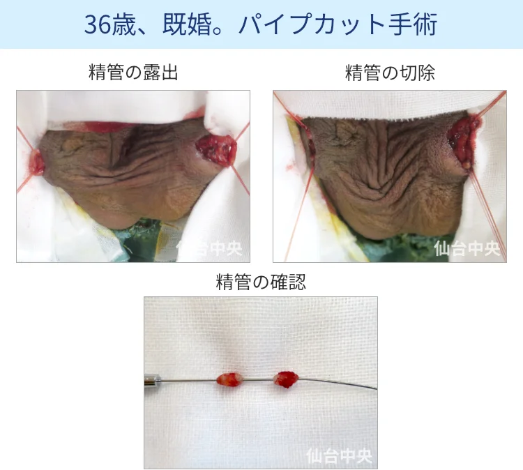 パイプカット手術の切開、露出、切除経過写真 - 30代男性