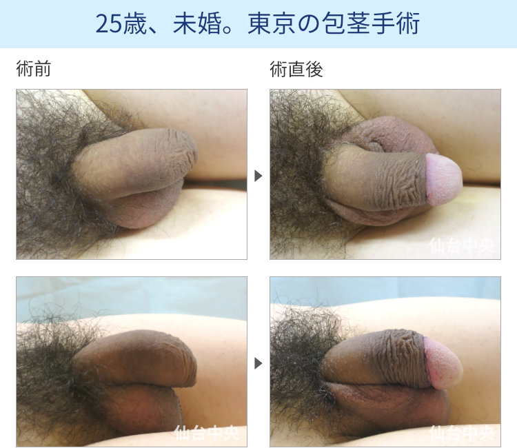 25歳、未婚。東京の包茎手術