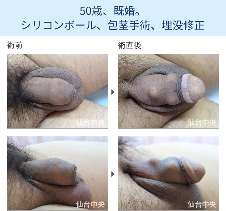 50歳、既婚。シリコンボール、包茎手術、埋没修正