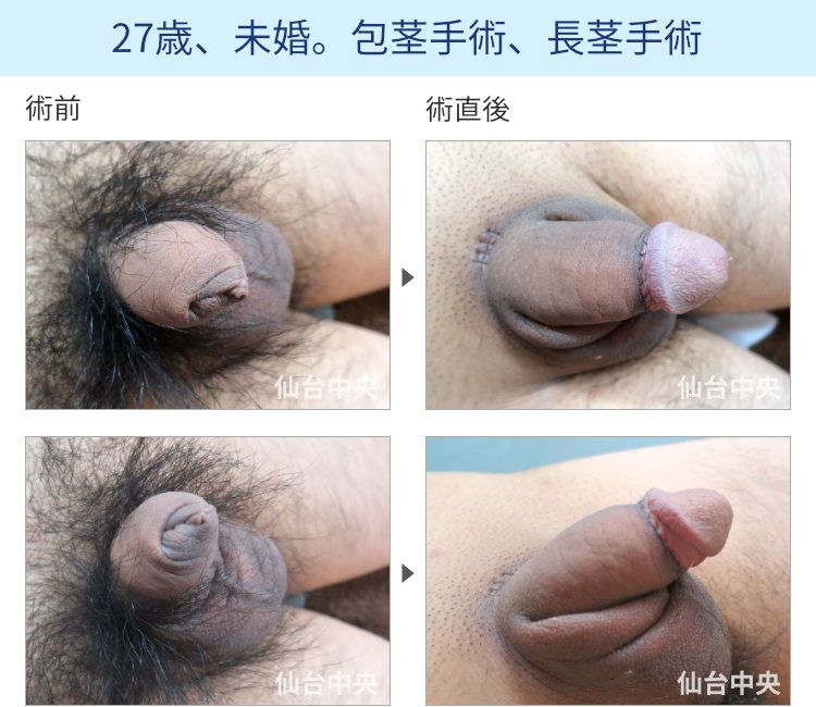 27歳、未婚。包茎手術、長茎手術の症例写真