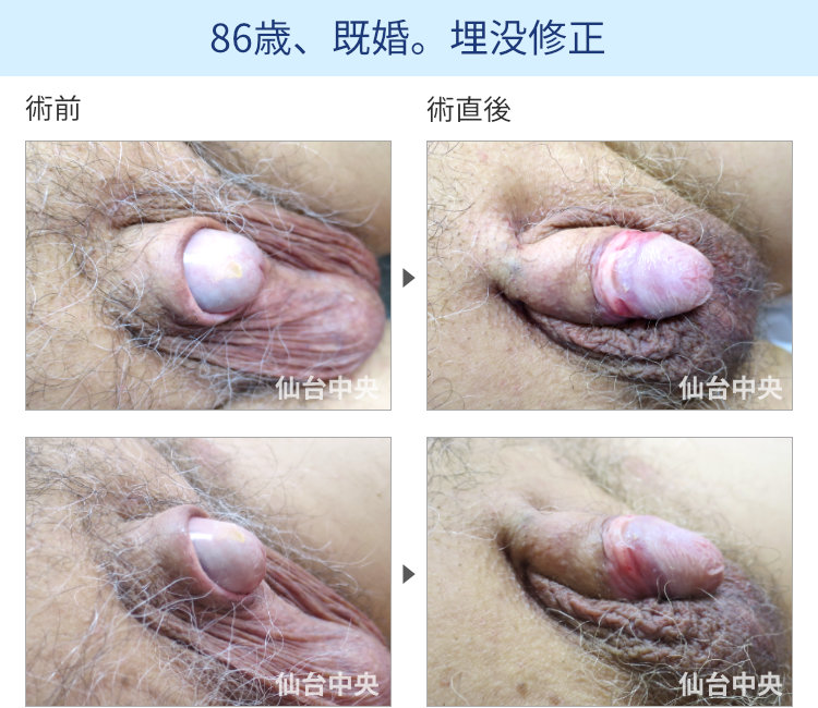 86歳、既婚。埋没修正の症例写真