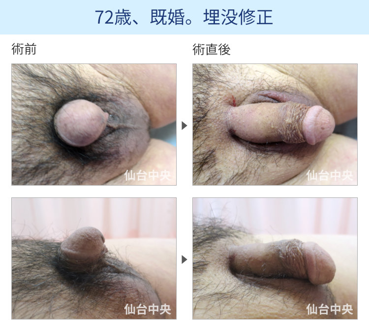 72歳、既婚。埋没修正の症例写真