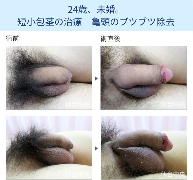 24歳、未婚。短小包茎の治療 亀頭のブツブツ除去の症例写真