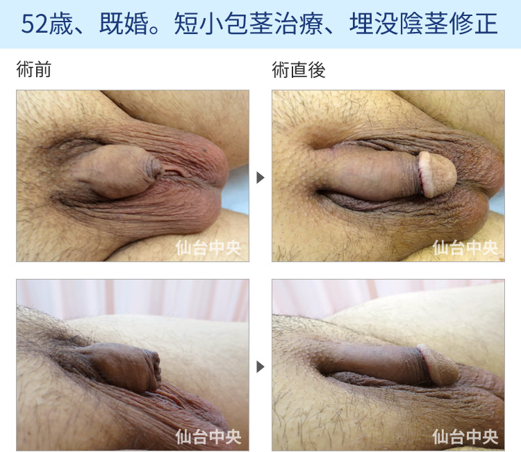 52歳、既婚。短小包茎治療、埋没陰茎修正