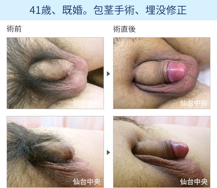 41歳、既婚。包茎手術、埋没修正