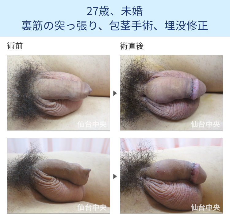 27歳、未婚。裏筋の突っ張り、包茎手術、埋没修正