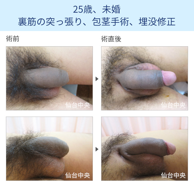 25歳、未婚。裏筋の突っ張り、包茎手術、埋没修正