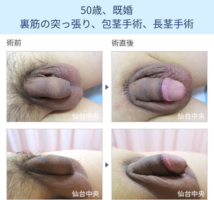 50歳、既婚。裏筋の突っ張り、包茎手術、長茎手術